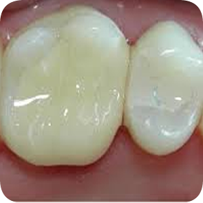 Composite Fillings