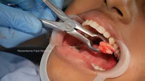 Impaction and Extractions at Chandigarh